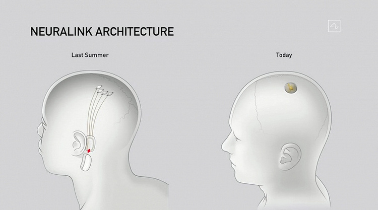 Маск показав оновлений нейроінтерфейс Neuralink – бездротовий чіп в формі монети Маск показав оновлений нейроінтерфейс Neuralink – бездротовий чіп в формі монети
