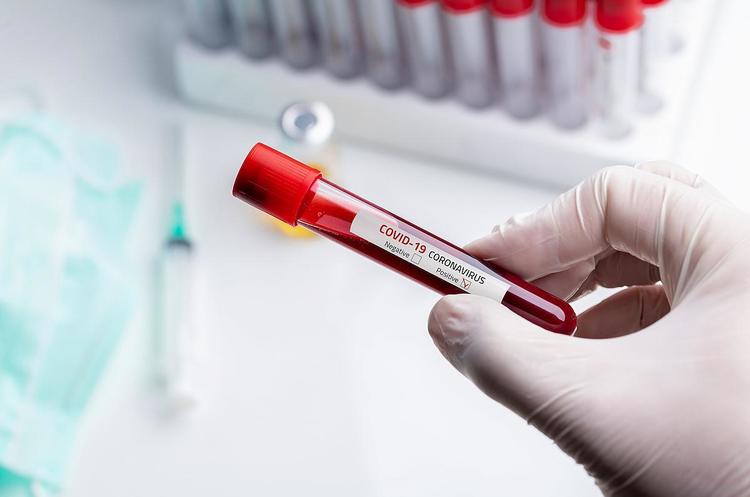 Через Prozorro закупили 15000 тестів на коронавірус за 7,2 млн грн