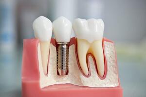 Уряд розширив програму безоплатного зубопротезування Уряд розширив програму безоплатного зубопротезування