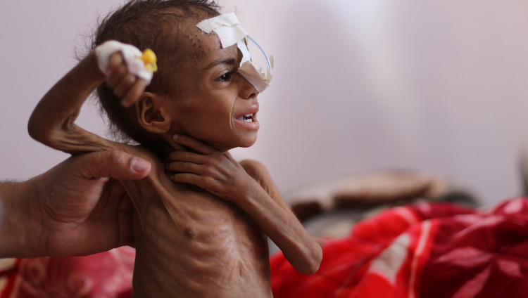 Истощение Йемена: как и зачем обе стороны войны усиливают голод